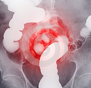 Barium enema or BE is image of large bowel .