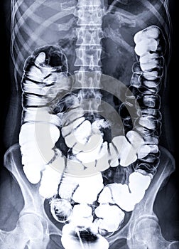 Barium enema or BE is image of large bowel AP view.