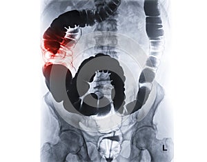 Barium enema or BE is image of large bowel after injection of barium contrast fill into colon under fluoroscopic control