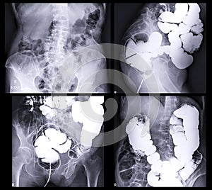 barium enema demonstrated cecum and colon for diagnosis Colorectal cancer or colon cancer photo