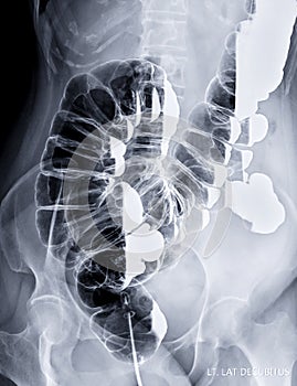 Barium enema image or BE  lateral Decubitus view. photo