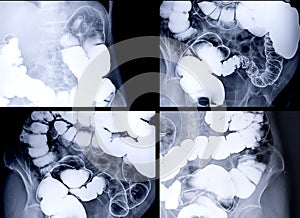 Barium enema image or BE  showing air and barium sulphate in colon or large intestine for detect colon cancer