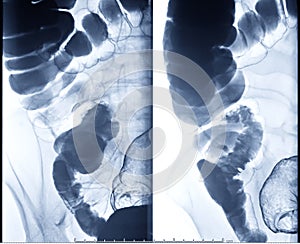 Barium enema image or x-ray image of large intestine or colon.