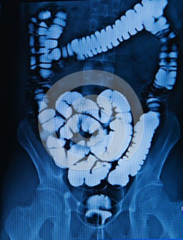 Barium enema of a man photo