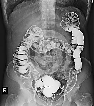 Barium enema of a man demonstrated the normal rectum and cecum. photo