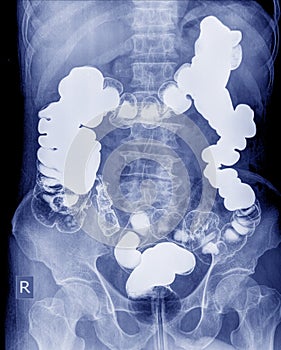 Barium enema of a man demonstrated the normal rectum and cecum. photo