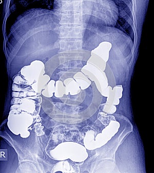 Barium enema of a man demonstrated the normal rectum and cecum. photo