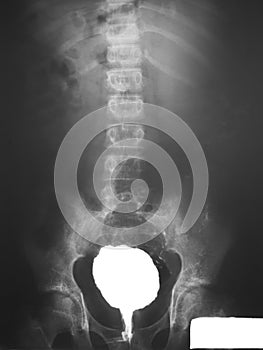 Barium enema of a patient, demonstrated obstruction of contrast media at rectal region and irregular rectal mucosa. photo