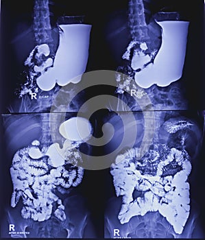 Barium meal and follow through examination x-ray. showing digestive system.