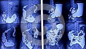 Barium meal and follow through examination x-ray. showing digestive system.