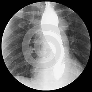 Barium swallow Evidence of achalasia at distal esophagus to EG junction.Moderate proximal dialtation of esophagus with