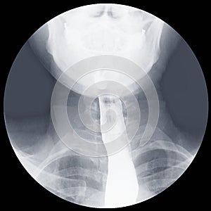 Barium swallow x-ray Evidence of achalasia at distal esophagus to EG junction.Moderate proximal dialtation of esophagus with photo