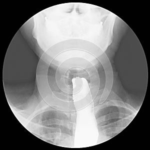 Barium swallow Evidence of achalasia at distal esophagus to EG junction.Moderate proximal dialtation of esophagus with photo