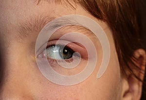 Barley in the eye. A child with barley in his eye. Inflammation of the eyelid. Human disease