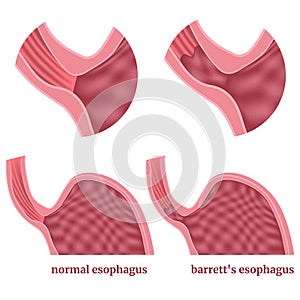 Barrett\'s esophagus. Diagram of stomach with disease.