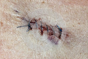 Basal Cell Carcinoma