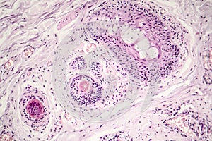 Basal cell carcinoma