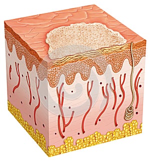 Basal cell carcinoma