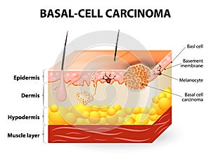 Basal-cell carcinoma or basal cell cancer photo