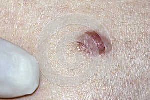 Basal Cell Carcinoma photo