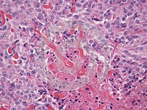 Histopathology ofBasal Cell Carcinoma photo