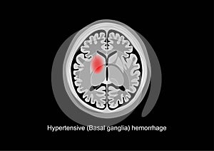 Basal ganglia hemorrhage brain scan illustration