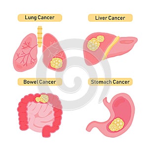 Cancer types flat  illustration.