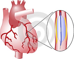 Angioplasty Diagram for Arterial Atherosclerosis