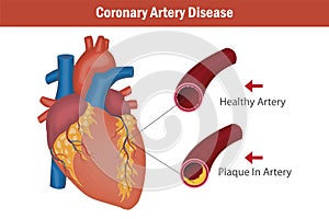 Coronary artery disease with artery plaque buildup.