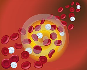 Cholesterol plaque in artery.