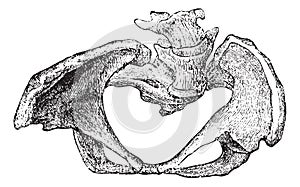 Basin deformed by rickets, vintage engraving