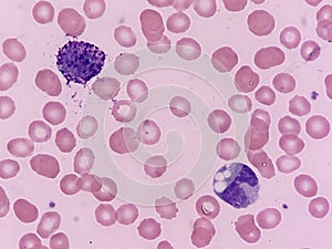 Basophil and neutrophil seen on peripheral blood smear