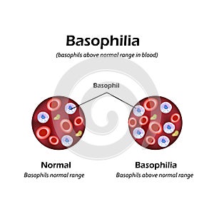 Basophils above the normal range in the blood. Basophilia. Infographics. Vector illustration photo