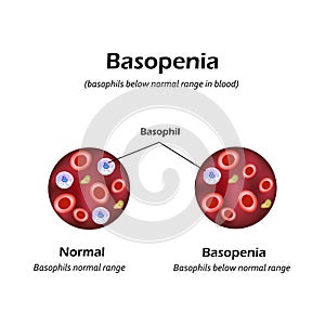 Basophils below the normal range in the blood. Basopenia. Infographics. Vector illustration photo