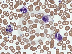 Basophils in chronic myelogenous leukemia. photo
