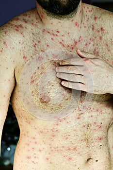 Man with chickenpox