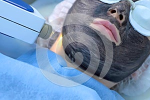 Beautician making laser carbon face peeling procedure to woman face, closeup.