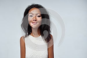 Beautiful African girl in studio with skin problems Vitiligo studio shooting photo