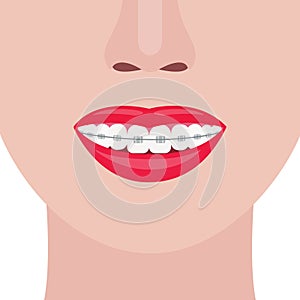Beautiful female smile with aesthetic braces. Tooth correction. Vector illustration