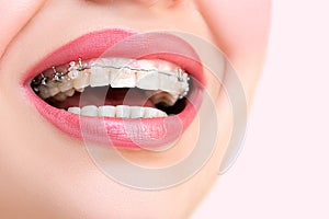 Beautiful Female Smile with Self-ligating Braces.