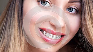 Beautiful Female Smile with Self-ligating Braces. Orthodontic Tr