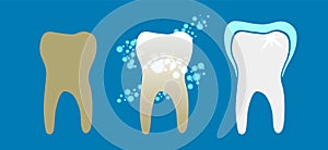 Beautiful flat dentist vector set of teeth cleansing process with decayed, cleansed and white shiny teeth on blue background