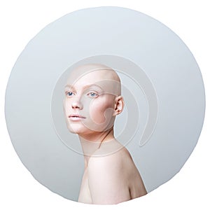 Beautiful girl with alopecia on a white background in a gray circle