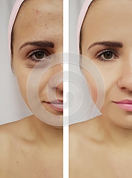 Beautiful girl face wrinkles before and after procedures