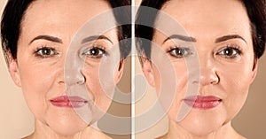 Beautiful mature woman before and after biorevitalization procedure on beige background