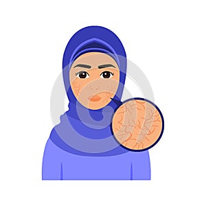 Beautiful Muslim Woman with Dry Skin on Face. Skin Problem. Closeup view. Pretty Lady in Hijab and Facial Cracks. Color Cartoon
