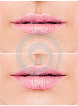 Beautiful pink lips after filler injection collagen