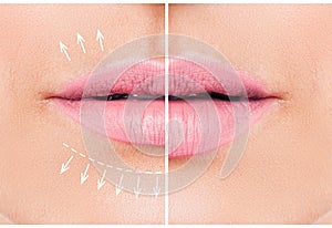 Beautiful pink lips before and after filler injection collagen