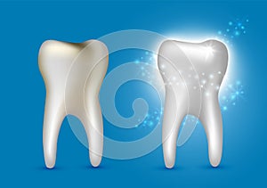 Beautiful realistic dentist vector set of decayed and white shiny cleansed tooth on blue background