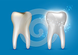 Beautiful realistic dentist vector set of decayed and white shiny cleansed tooth on blue background photo